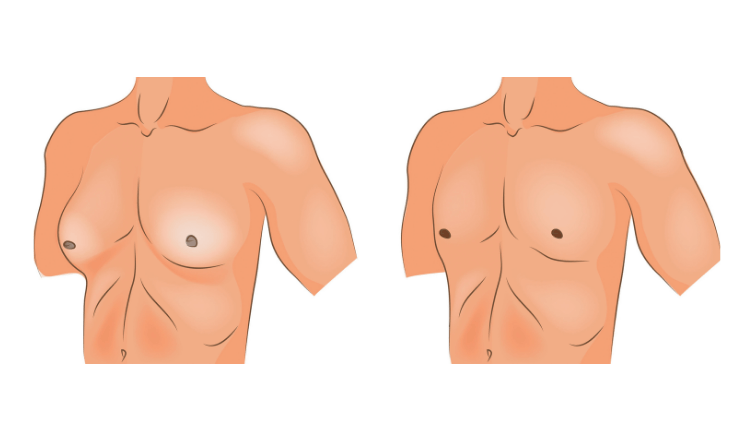 so sánh nữ hóa tuyến vú ở nam giới và vú bình thường 