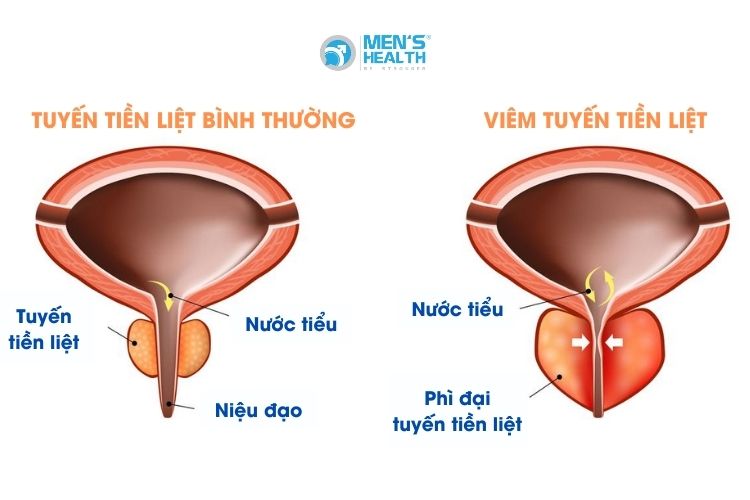 Hình ảnh minh họa giữa tuyến tiền liệt bình thường và viêm tuyến tiền liệt