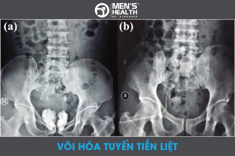 Có những biện pháp điều trị nào hiệu quả cho vôi hóa tuyến tiền liệt?
