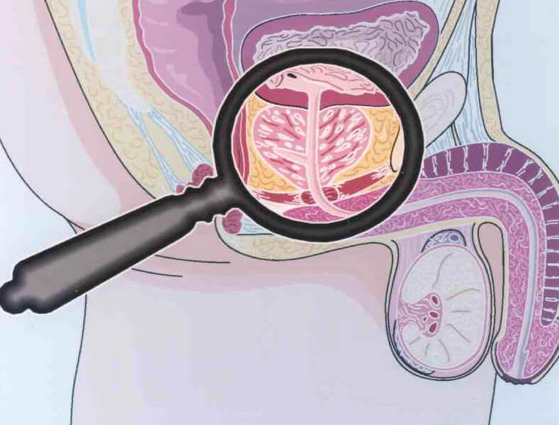 What Are the Long-Term Effects of Untreated Prostatitis in Men?
