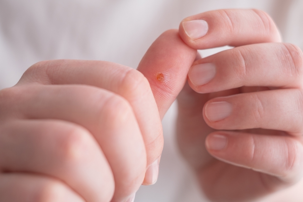 Thắc mắc: Quan hệ bằng tay có bị sùi mào gà không?