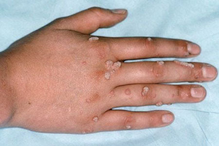 Sùi mào gà ở tay sau khi quan hệ với nguồn bệnh